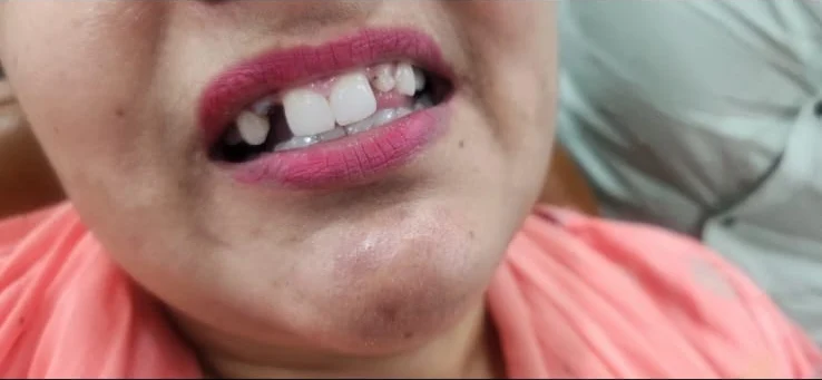 Implant treatment — clinical view