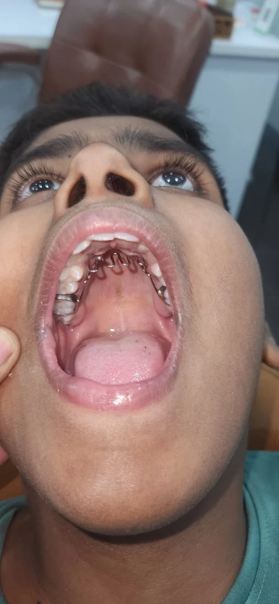 Thumb-sucking appliance